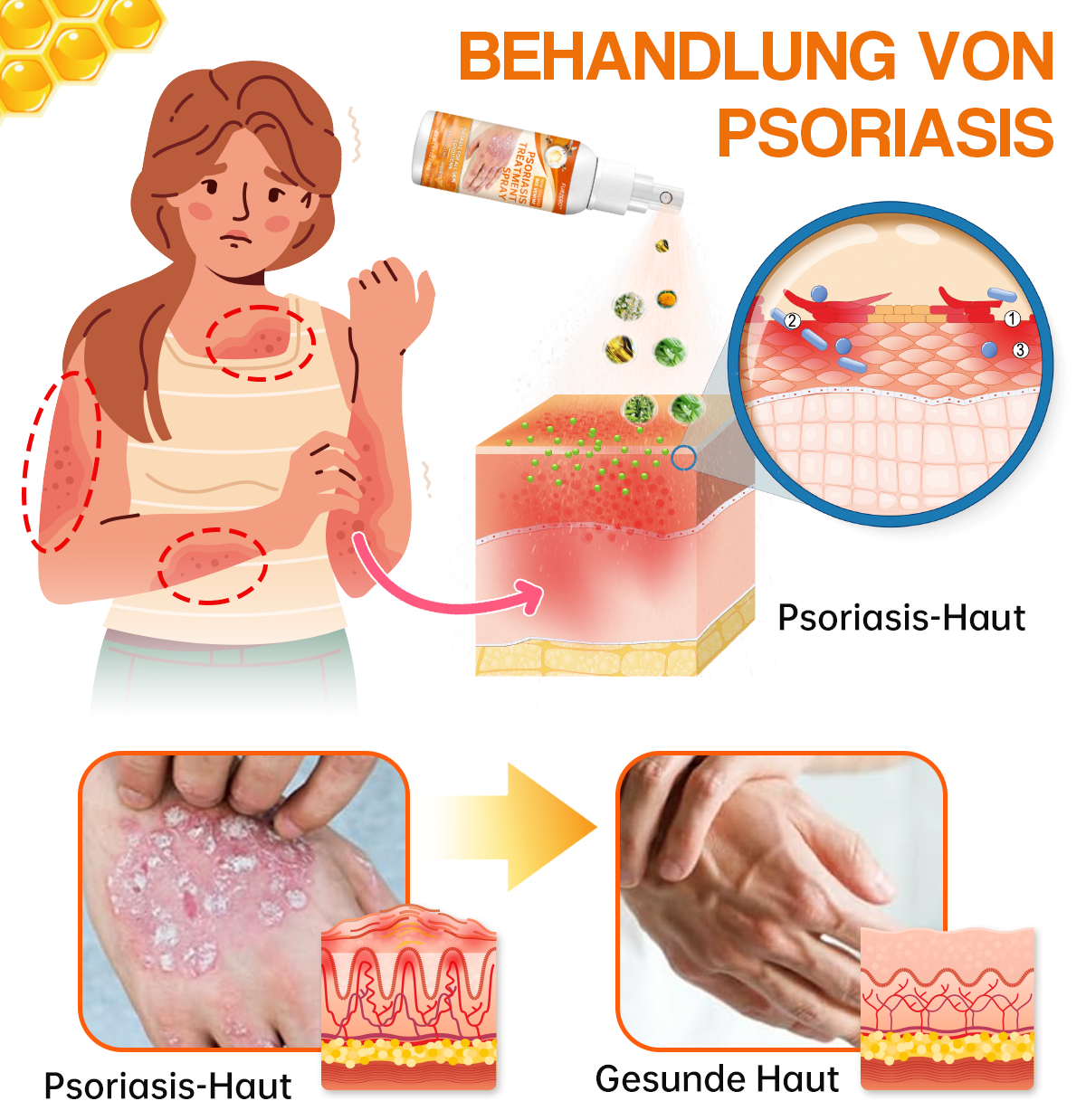 1+1 GRATIS | Psoriasisbehandelingsspray, bevrijd uw huid vandaag nog!