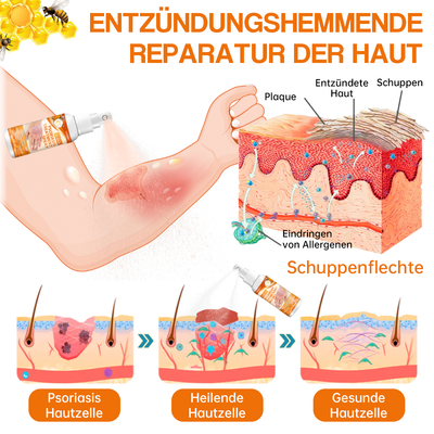 1+1 GRATIS | Psoriasisbehandelingsspray, bevrijd uw huid vandaag nog!