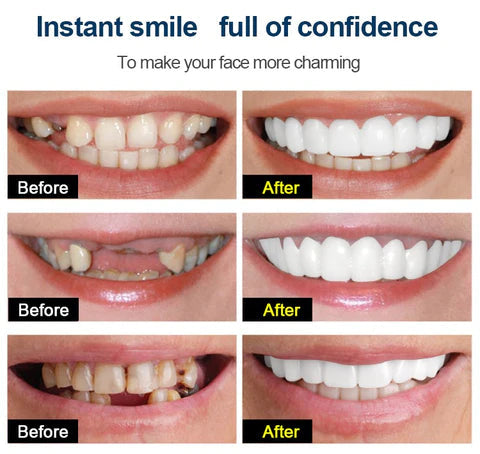 SmileFix™ - Creëer het perfecte gebit | ALLEEN VANDAAG 1+1 GRATIS